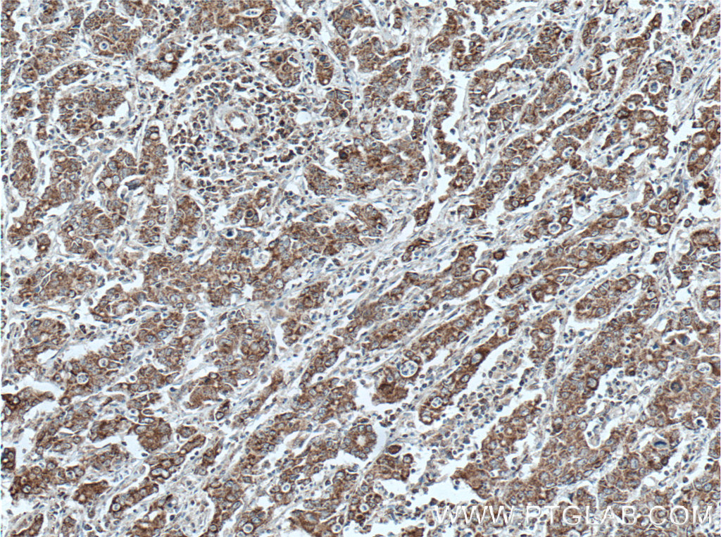 IHC staining of human stomach cancer using 60052-1-Ig (same clone as 60052-1-PBS)