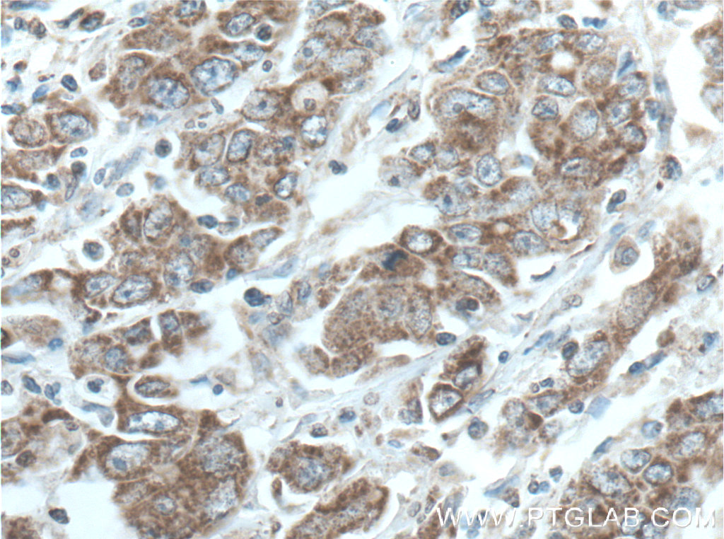 IHC staining of human stomach cancer using 60052-1-Ig (same clone as 60052-1-PBS)