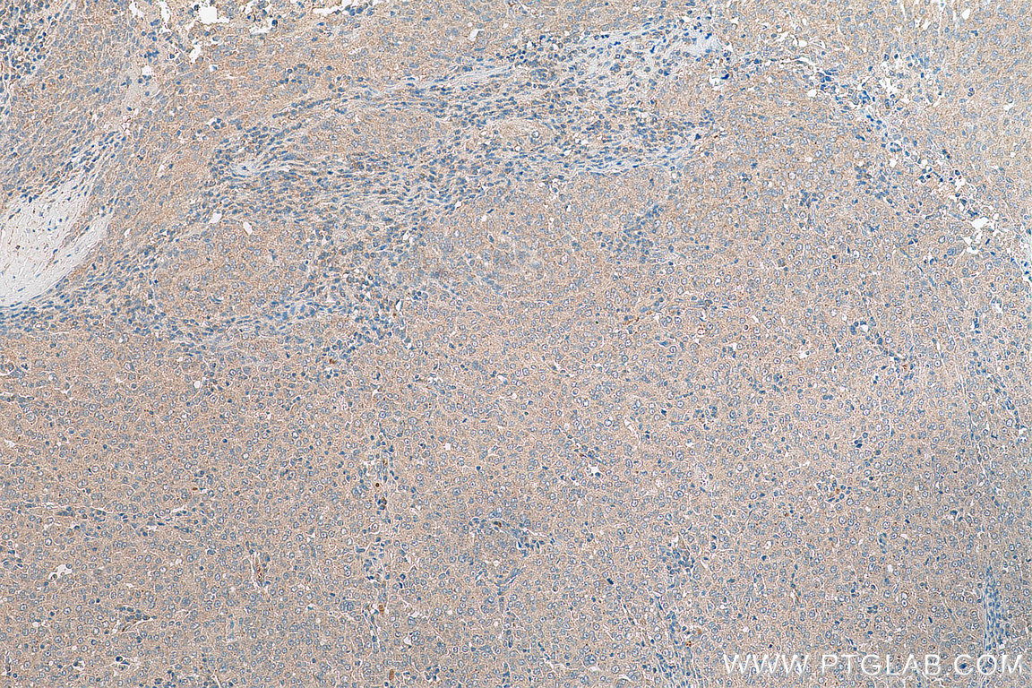 IHC staining of human ovary tumor using 18277-1-AP