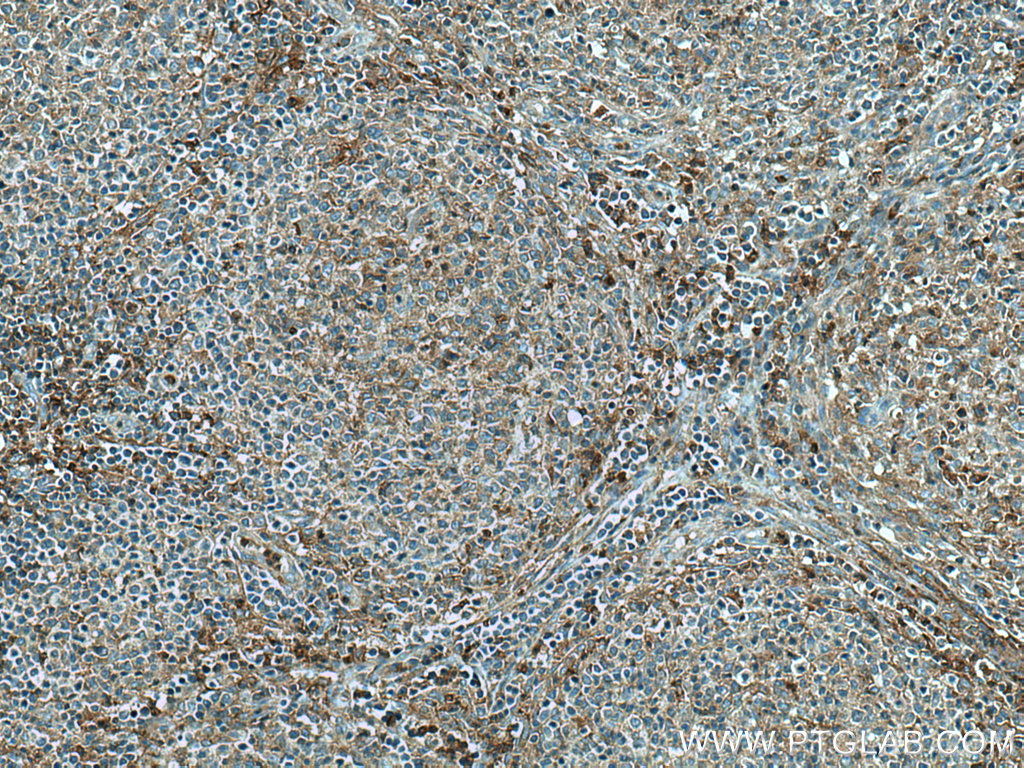 IHC staining of human lymphoma using 13301-1-AP