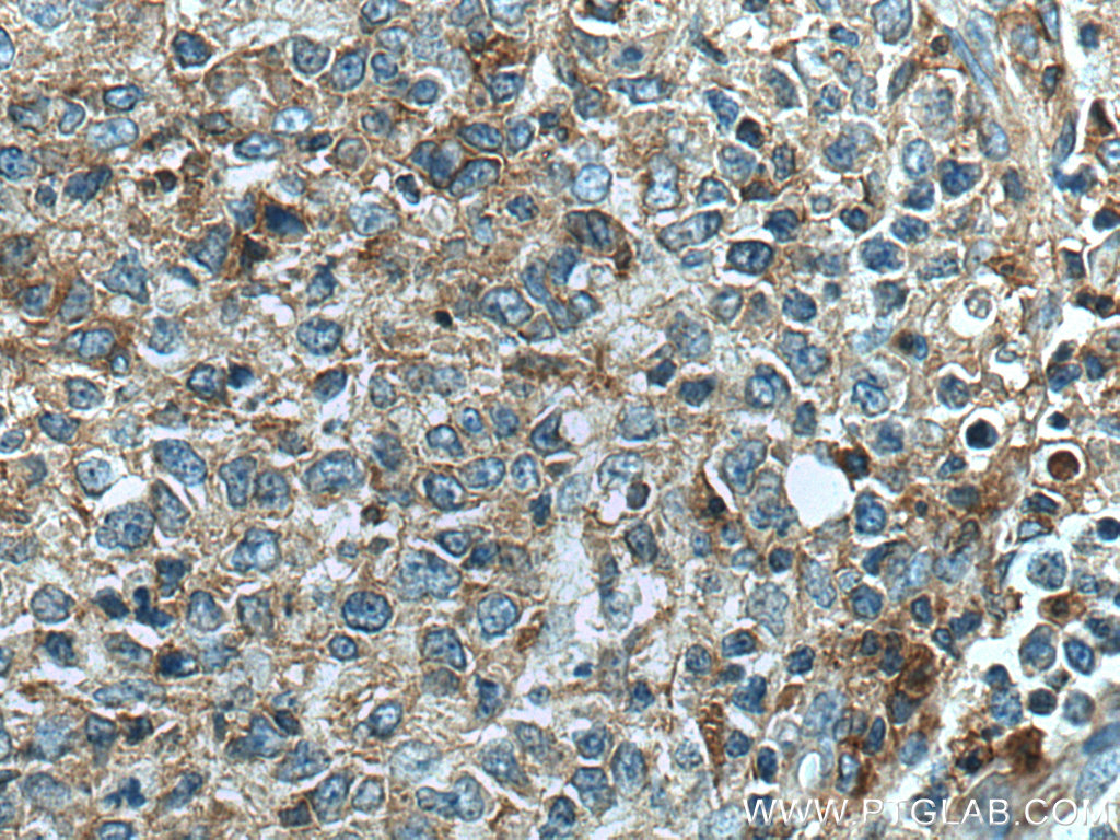 IHC staining of human lymphoma using 13301-1-AP