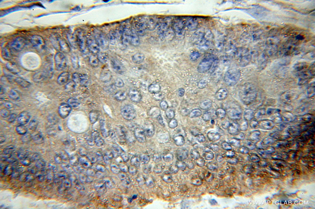 IHC staining of human colon cancer using 11201-1-AP