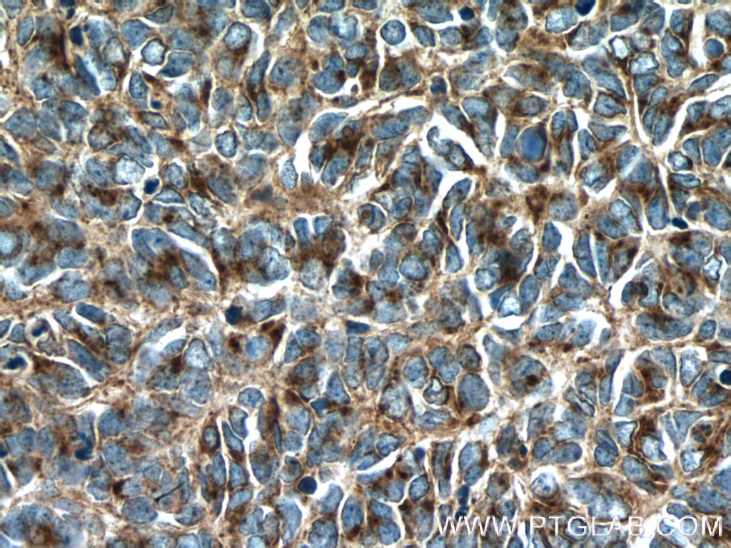 IHC staining of human medulloblastoma using 12322-1-AP