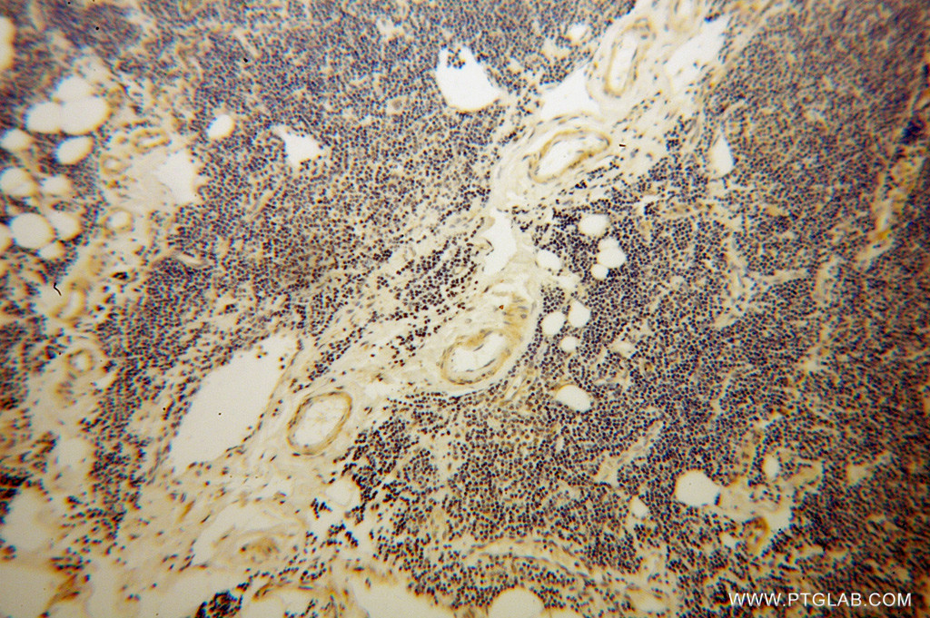 IHC staining of human lymphoma using 13764-1-AP