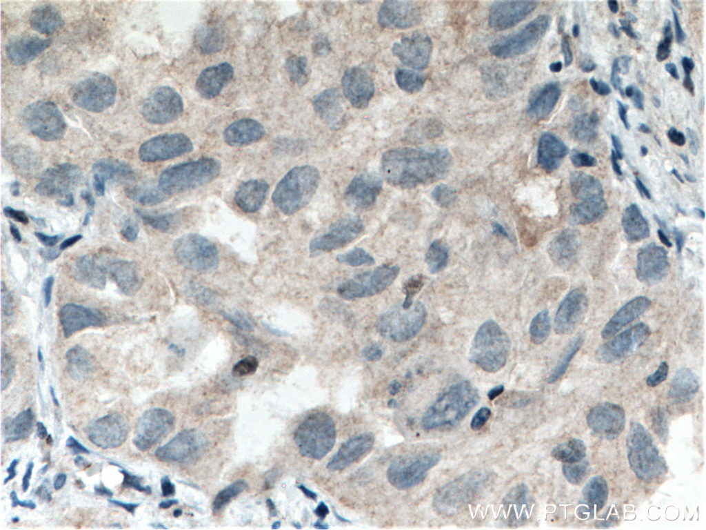 IHC staining of human lung cancer using 10976-4-AP