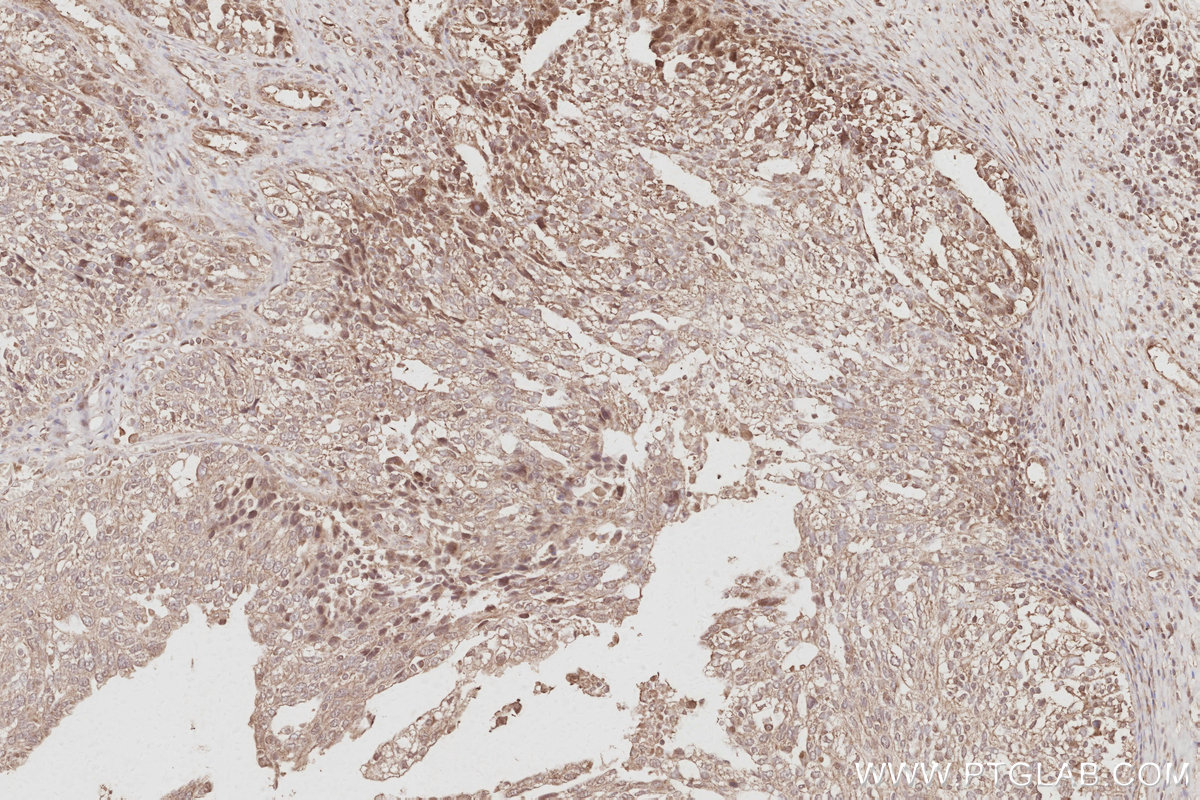 IHC staining of human ovary cancer using 16433-1-AP IHC staining of human ovary cancer using 16433-1-AP