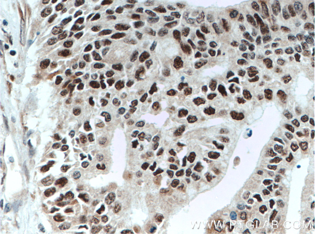 IHC staining of human pancreas cancer using 10948-2-AP