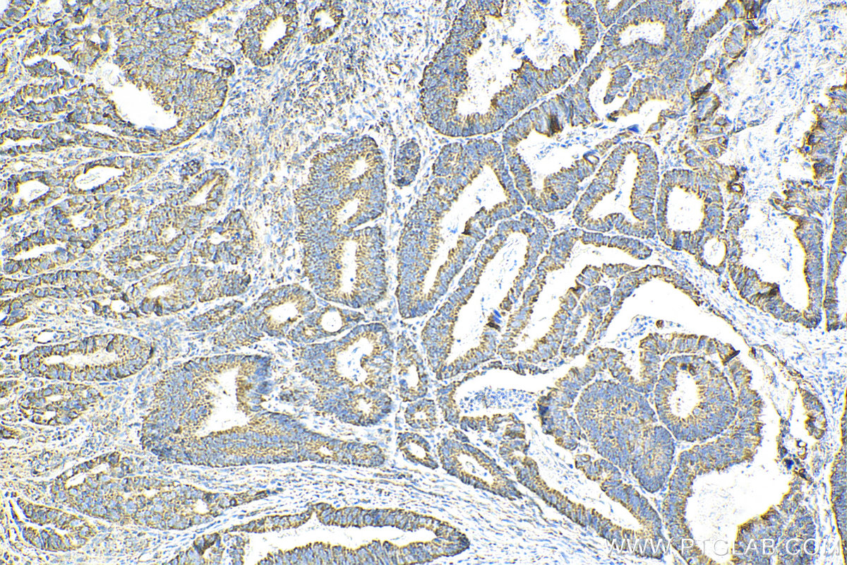 IHC staining of human colon cancer using 12627-1-AP