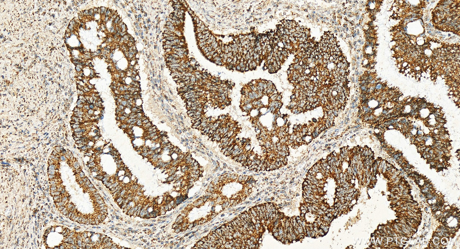 IHC staining of human colon cancer using 68549-1-Ig (same clone as 68549-1-PBS)