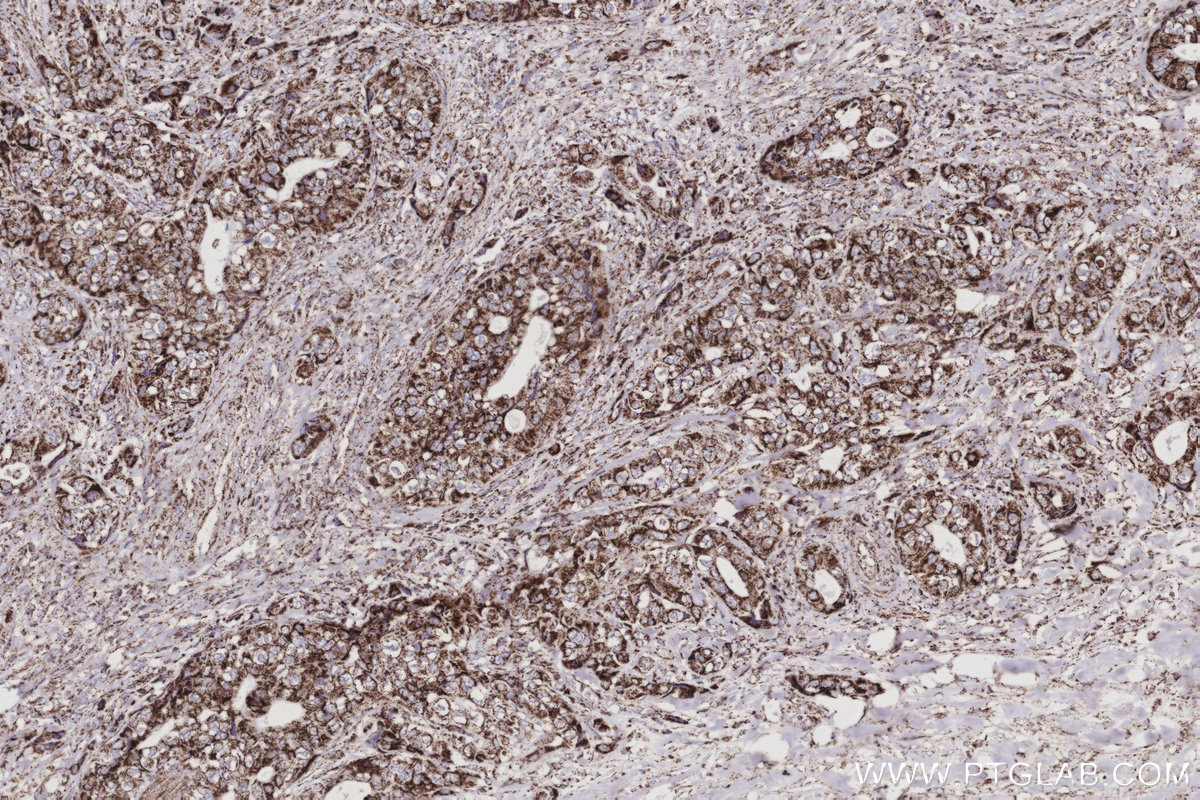 IHC staining of human pancreas cancer using 68549-1-Ig IHC staining of human pancreas cancer using 68549-1-Ig
