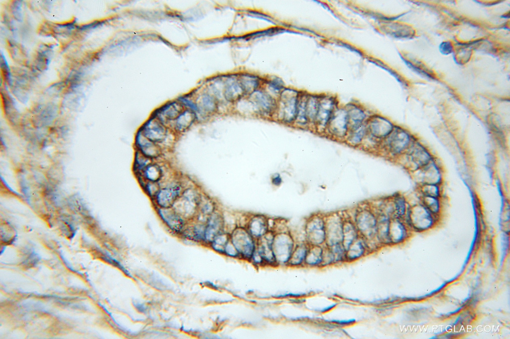 IHC staining of human pancreas cancer using 11675-1-AP