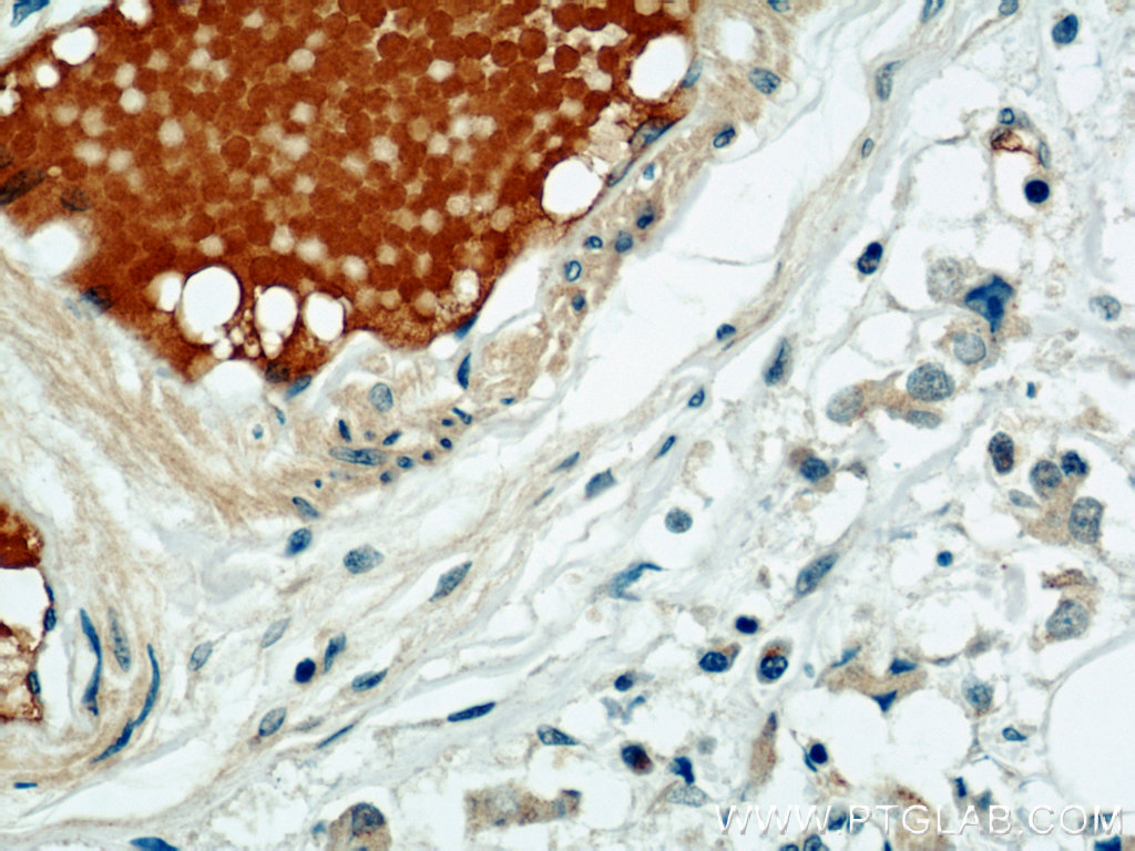 IHC staining of human breast cancer using 12260-1-AP