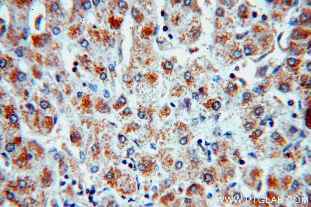 IHC staining of human hepatocirrhosis using 19499-1-AP