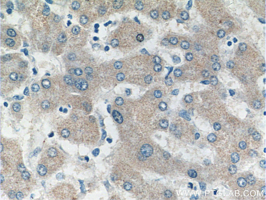 IHC staining of human liver cancer using 16050-1-AP