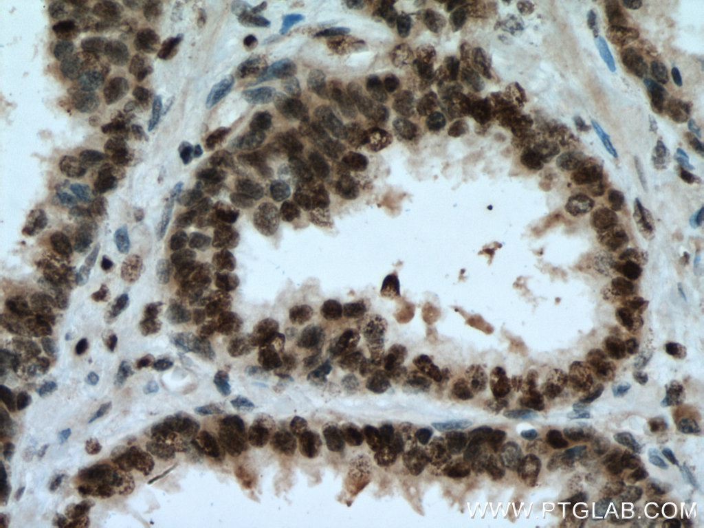 IHC staining of human prostate cancer using 67154-1-Ig