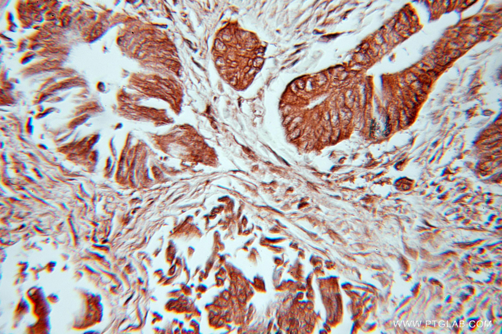 IHC staining of human colon cancer using 10947-1-AP