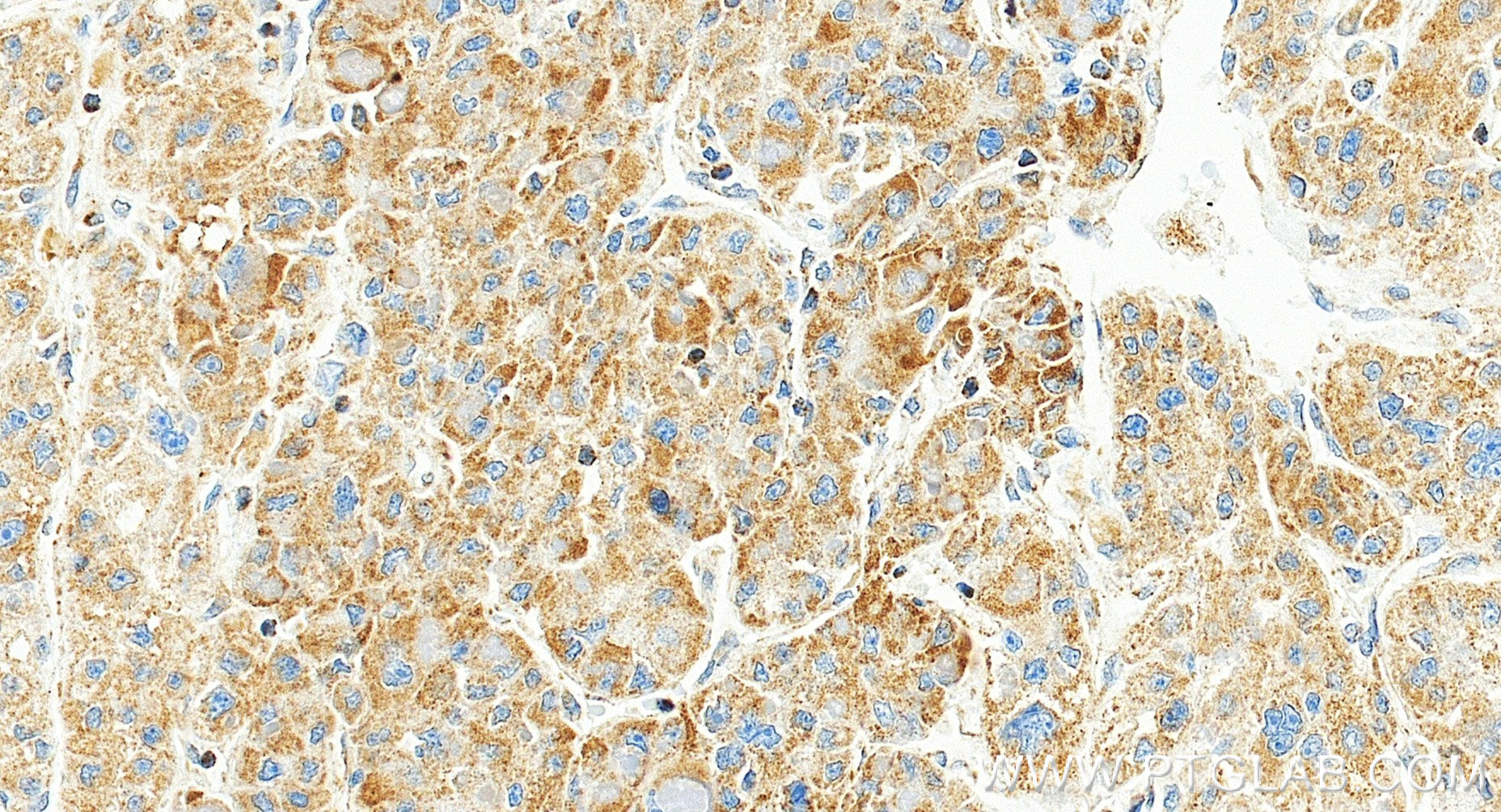 IHC staining of human liver cancer using 86706-1-RR (same clone as 86706-1-PBS)