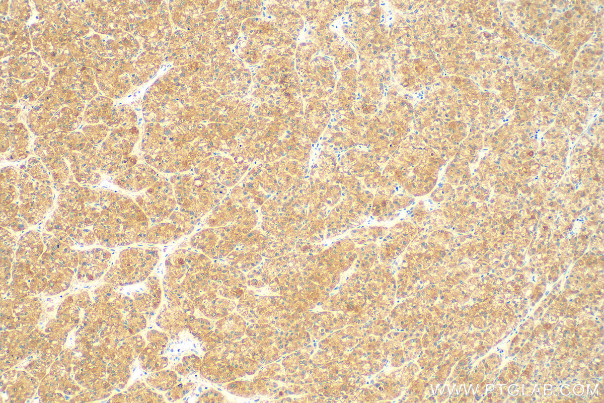 IHC staining of human liver cancer using 83052-5-RR