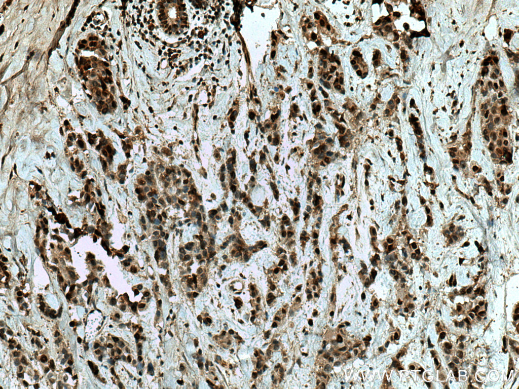 IHC staining of human breast cancer using 16522-1-AP