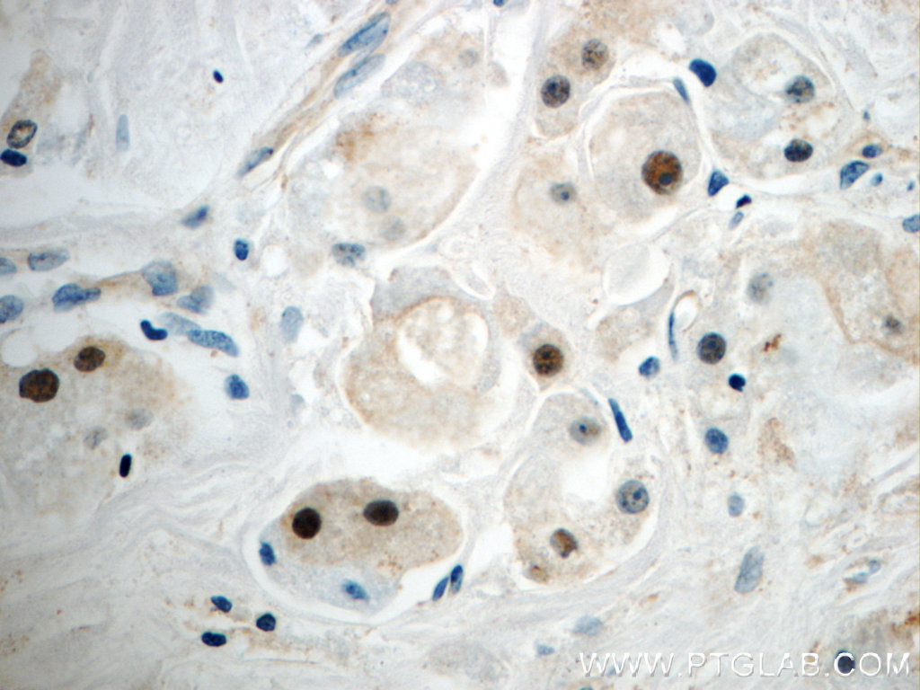 IHC staining of human breast cancer using 20366-1-AP