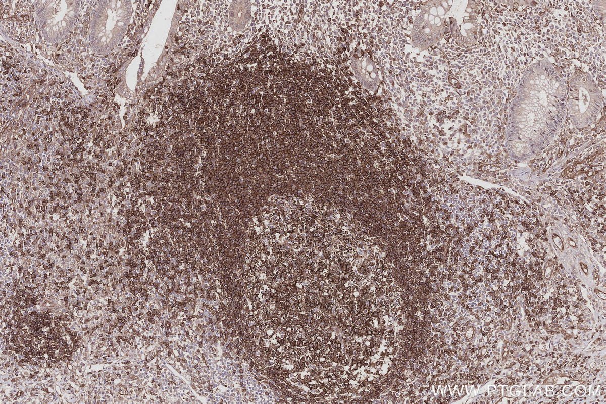 IHC staining of human appendicitis using 31042-1-AP IHC staining of human appendicitis using 31042-1-AP