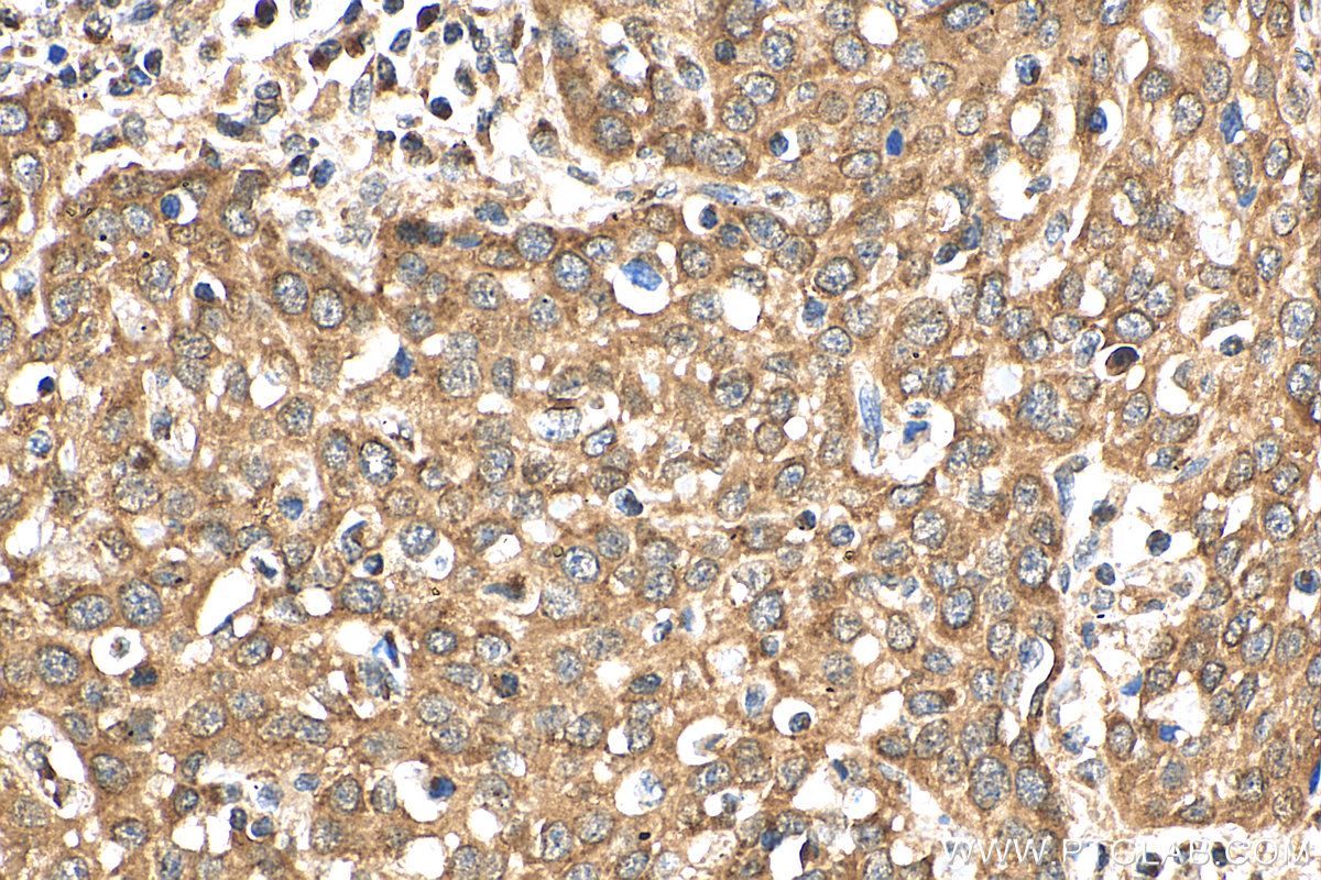 IHC staining of human cervical cancer using 16272-1-AP