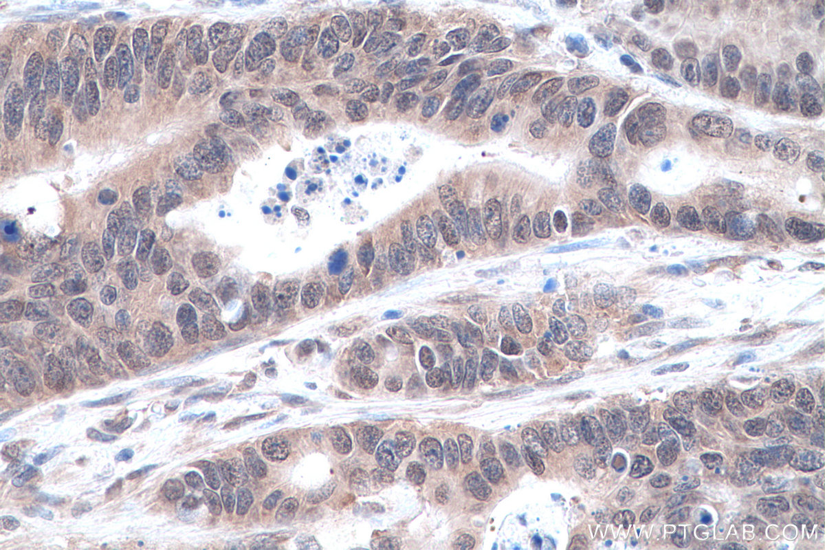 IHC staining of human colon cancer using 14024-1-AP