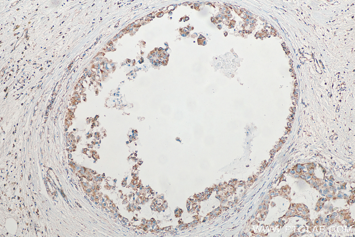 IHC staining of human breast cancer using 12359-1-AP