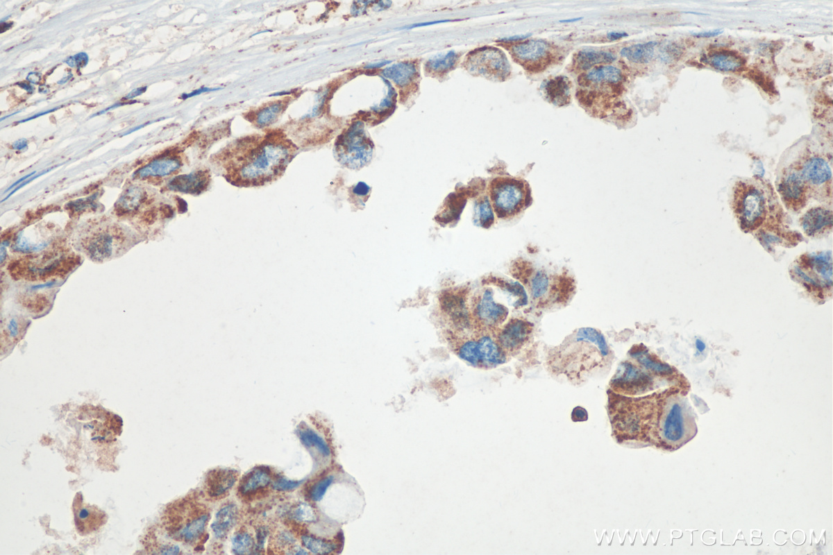IHC staining of human breast cancer using 12359-1-AP