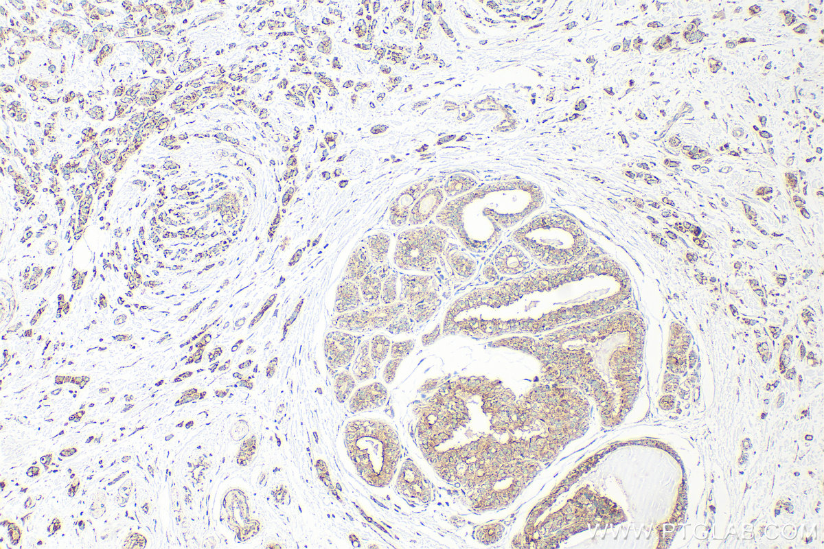 IHC staining of human breast cancer using 12359-1-AP IHC staining of human breast cancer using 12359-1-AP