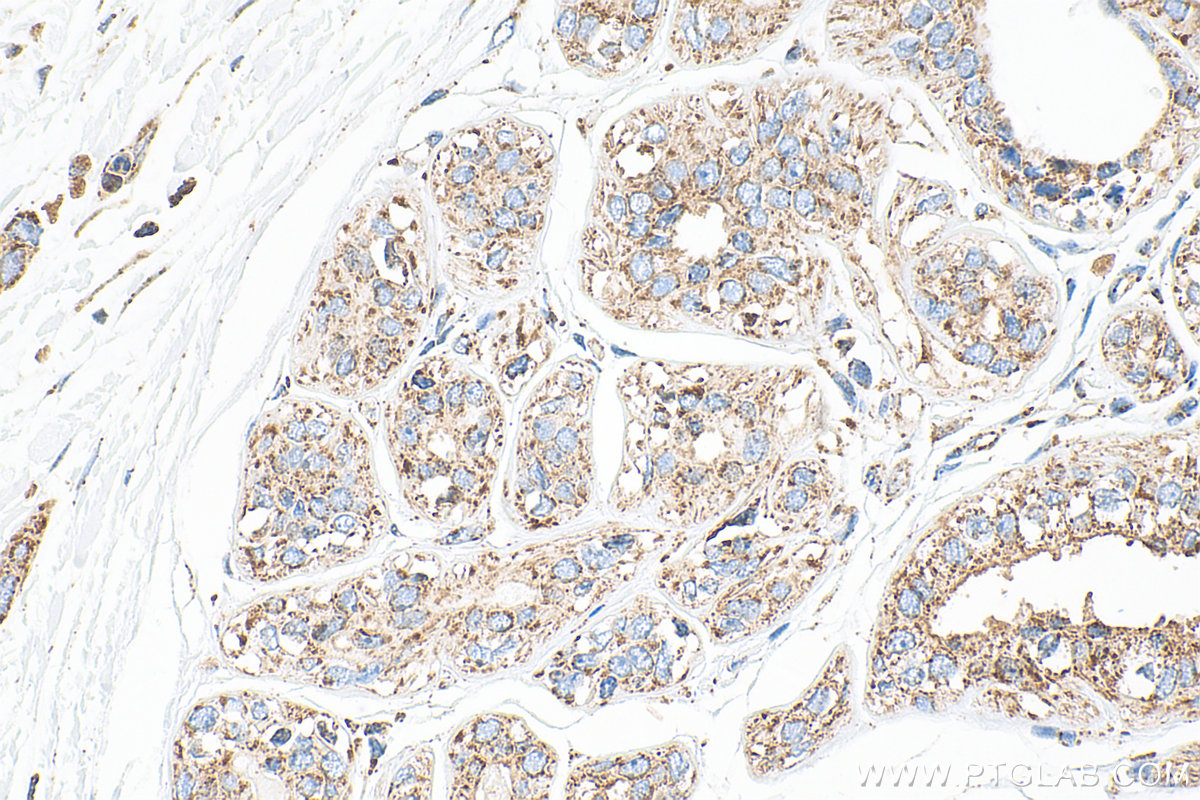 IHC staining of human breast cancer using 12359-1-AP IHC staining of human breast cancer using 12359-1-AP