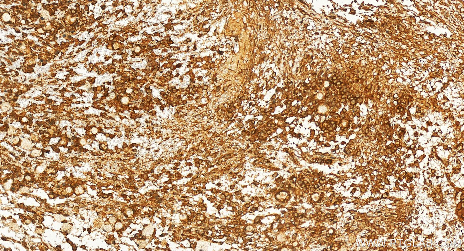IHC staining of human ovary cancer using 24844-1-AP