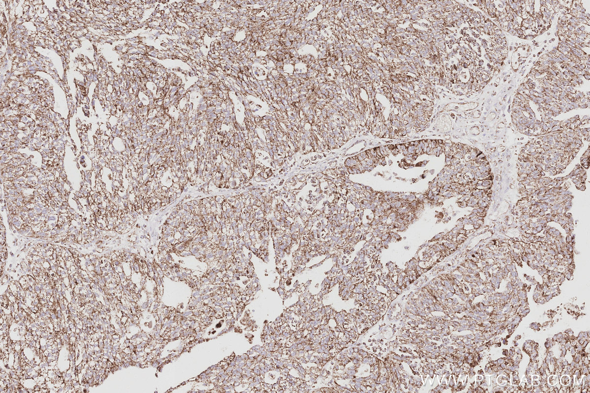 IHC staining of human ovary cancer using 28679-1-AP IHC staining of human ovary cancer using 28679-1-AP