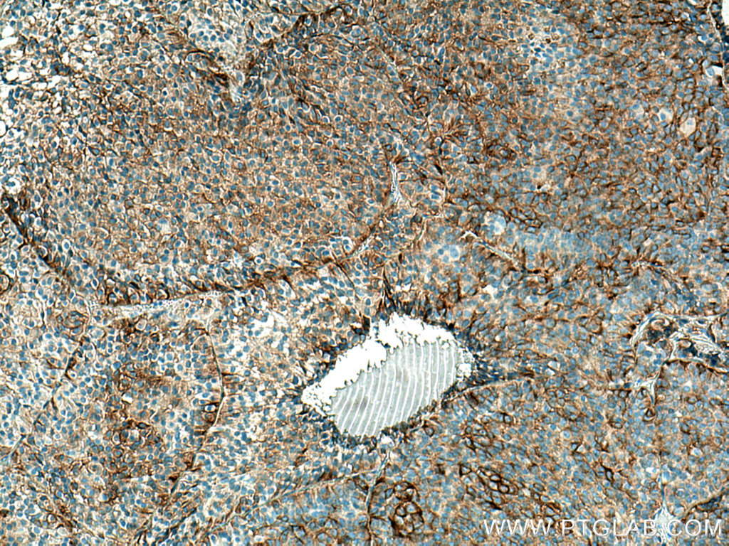 IHC staining of human pituitary adenoma using 67406-1-Ig (same clone as 67406-1-PBS)