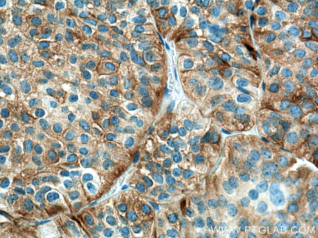 IHC staining of human pituitary adenoma using 67406-1-Ig