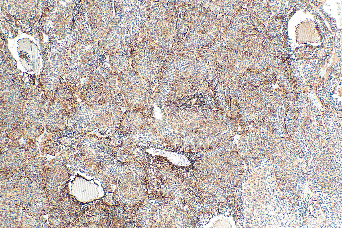 IHC staining of human pituitary adenoma using 67406-1-Ig IHC staining of human pituitary adenoma using 67406-1-Ig