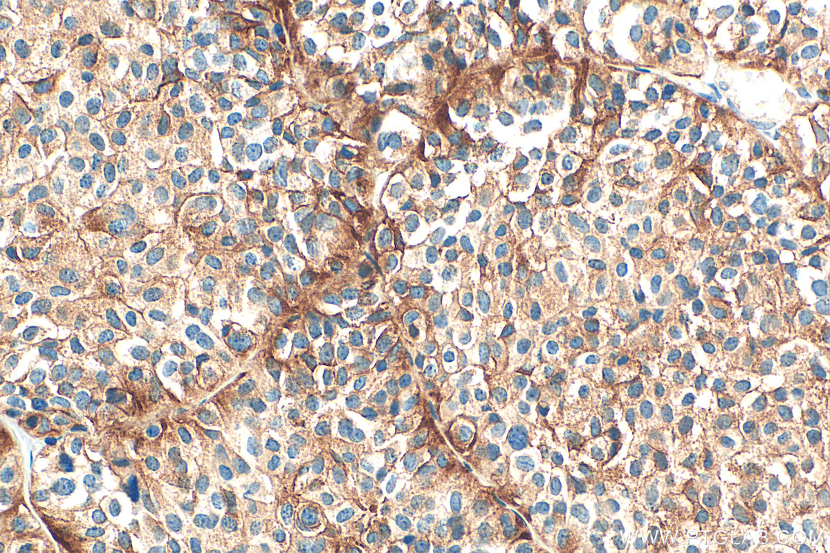 IHC staining of human pituitary adenoma using 67406-1-Ig IHC staining of human pituitary adenoma using 67406-1-Ig