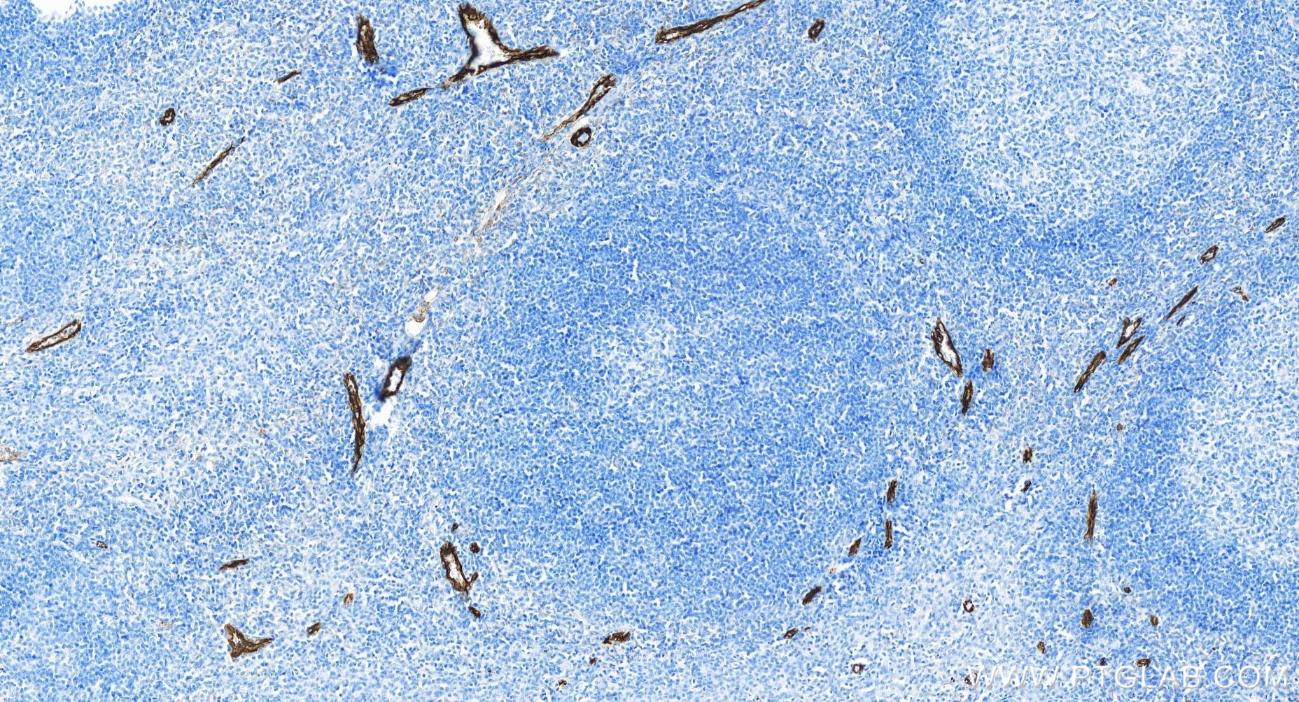 IHC staining of human tonsillitis using 83947-5-RR
