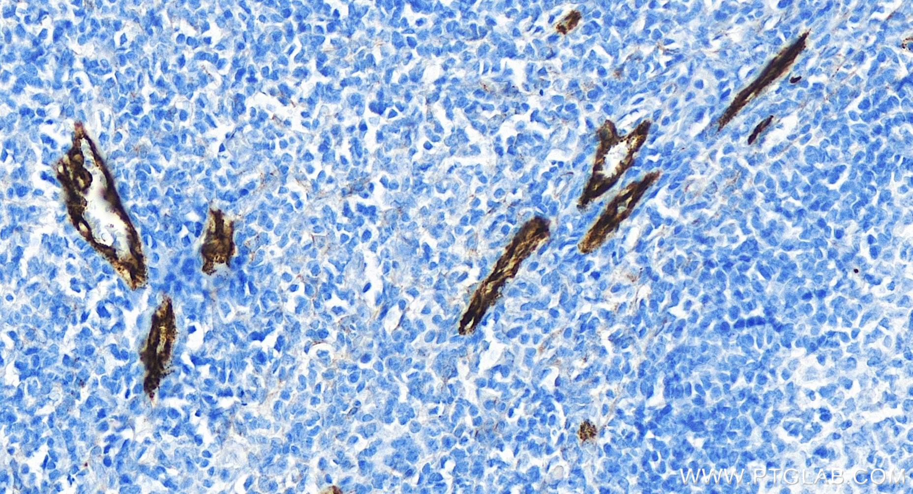 Immunohistochemical analysis of paraffin-embedded human tonsillitis tissue slide using 83947-5-RR (P-Selectin/CD62P antibody) at dilution of 1:800 (under 40x lens). Heat mediated antigen retrieval with Tris-EDTA buffer (pH 9.0). IHC staining of human tonsillitis using 83947-5-RR