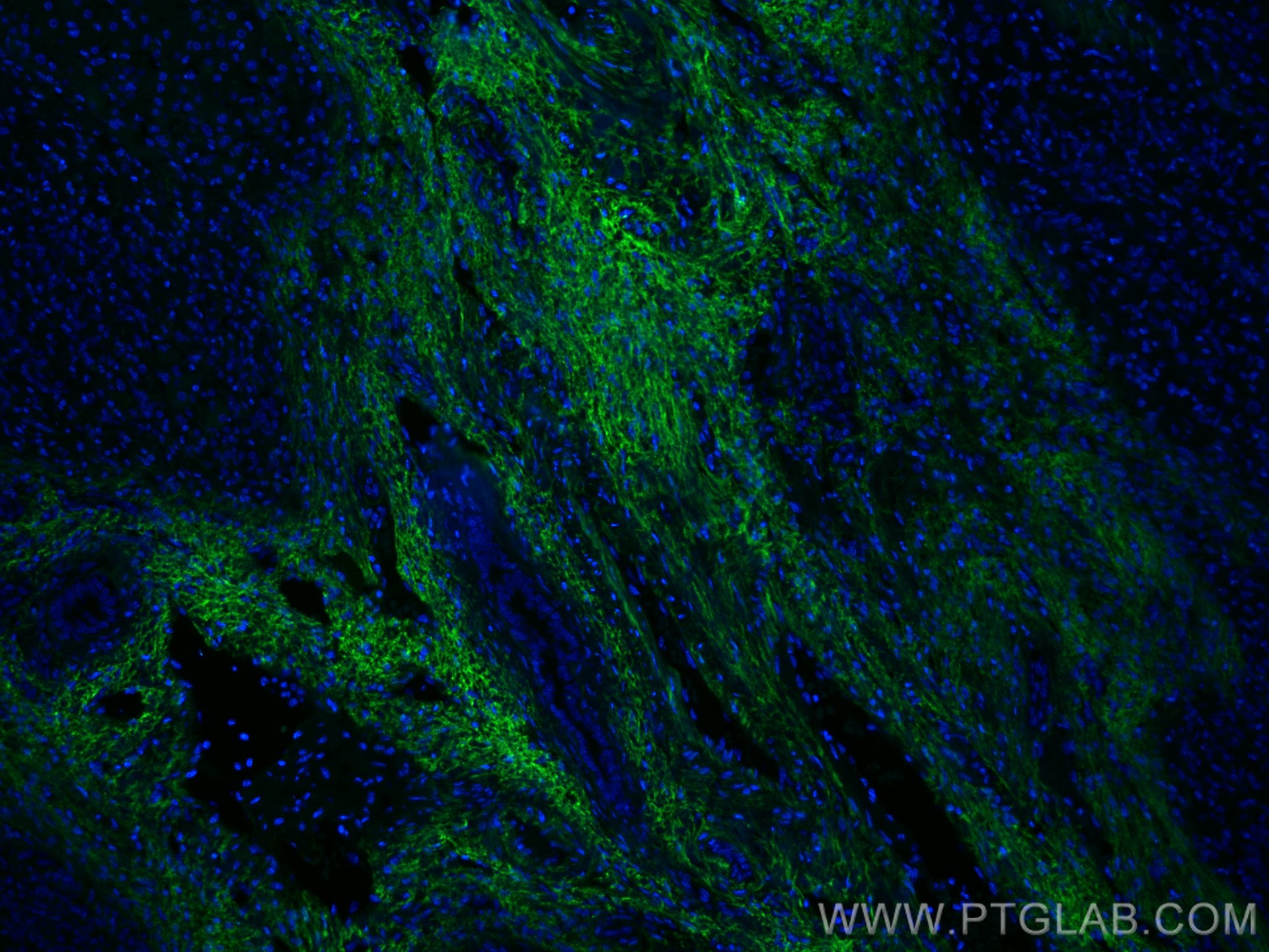 IF Staining of human liver cancer using CL488-66084