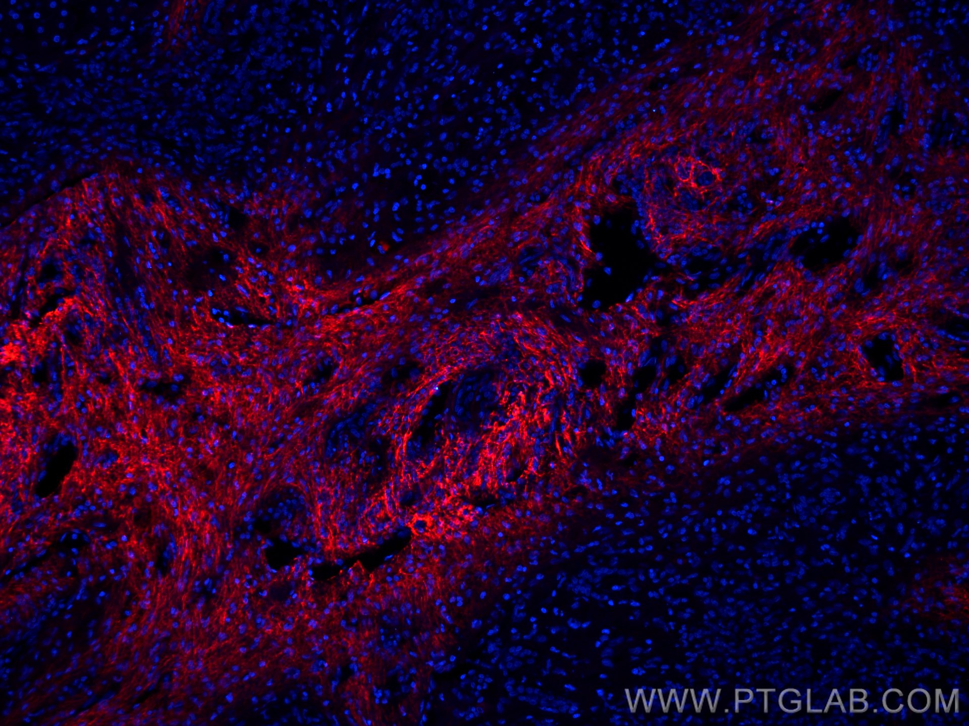IF Staining of human liver cancer using CL594-66084