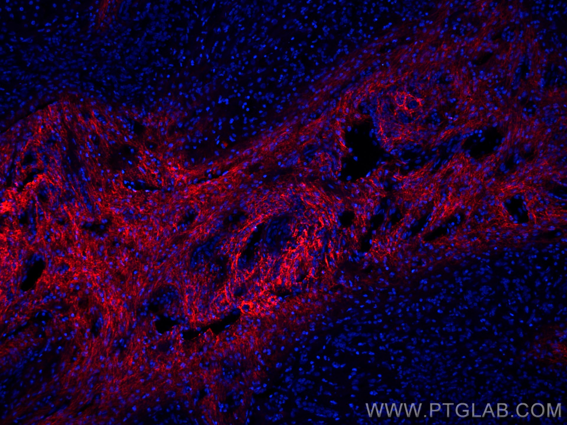 IF Staining of human liver cancer using CL594-66084