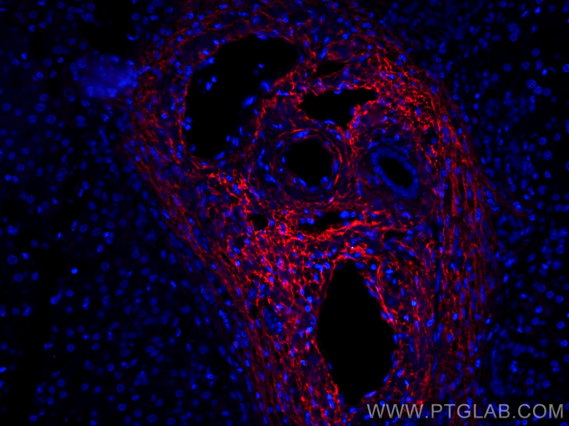 IF Staining of human liver cancer using CL594-66084