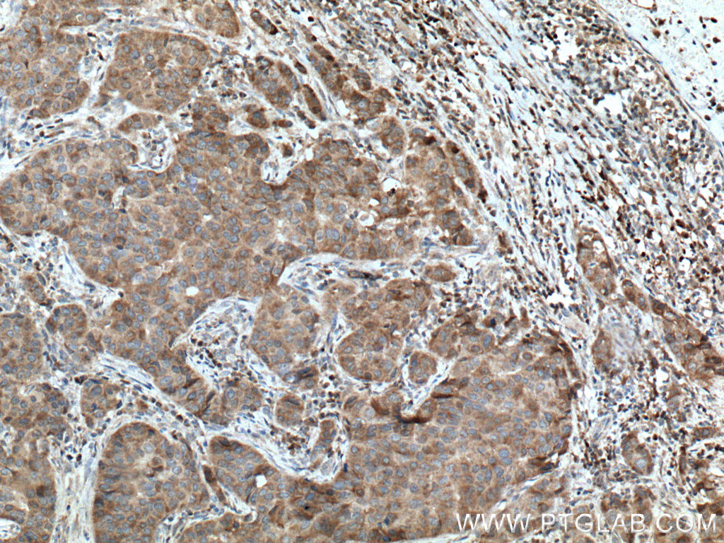 IHC staining of human breast cancer using 10795-1-AP