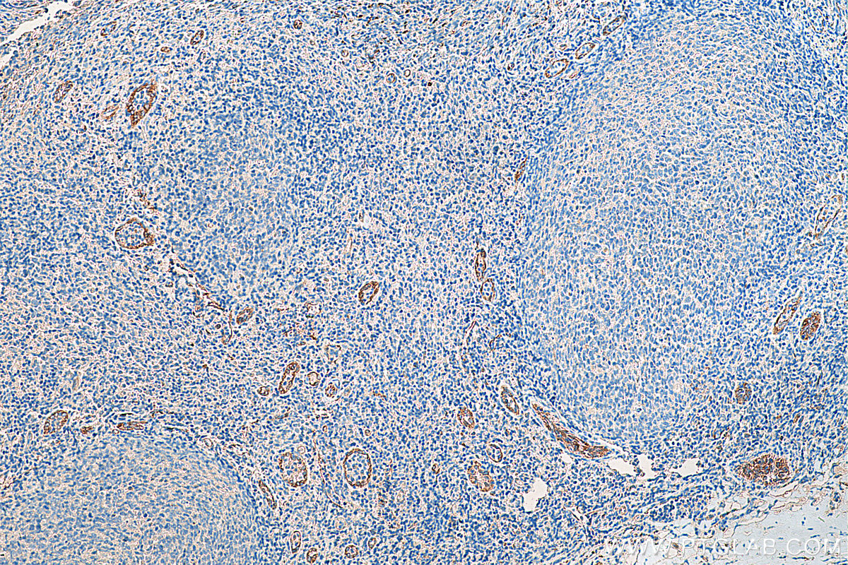 IHC staining of human tonsillitis using 20663-1-AP