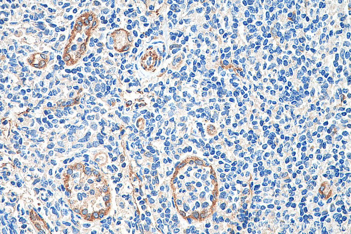 IHC staining of human tonsillitis using 20663-1-AP