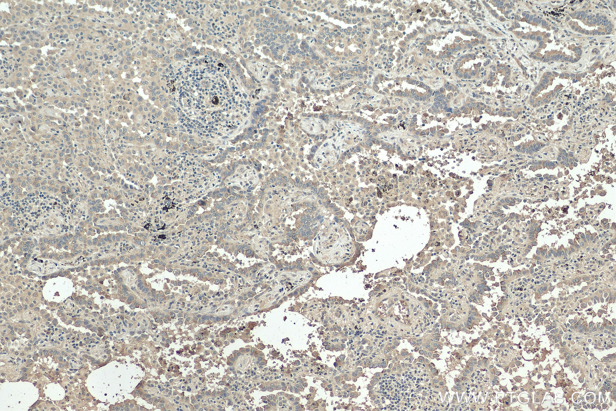 IHC staining of human lung cancer using 67894-1-Ig (same clone as 67894-1-PBS)
