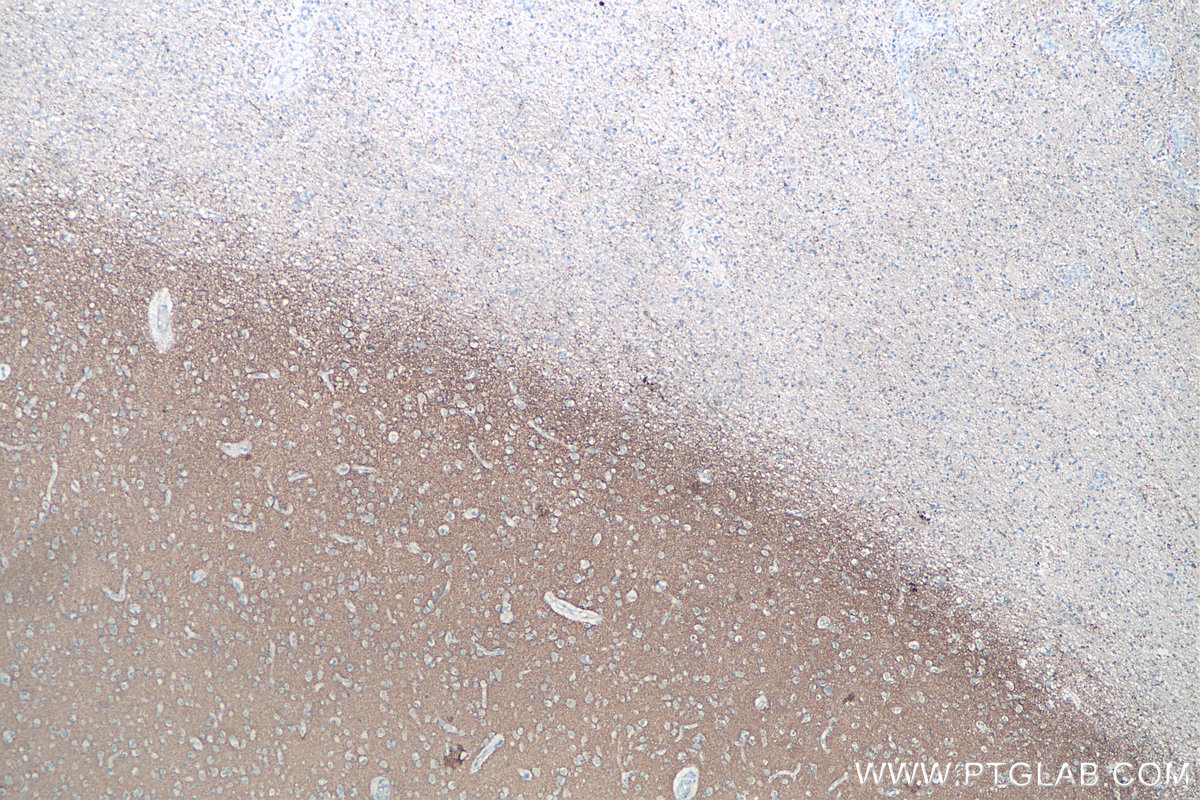 IHC staining of human gliomas using 67864-1-Ig