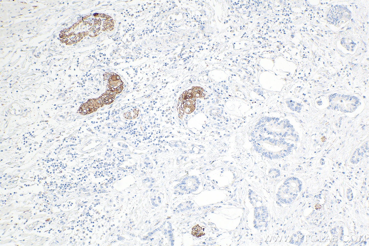 IHC staining of human rectal cancer using 67864-1-Ig