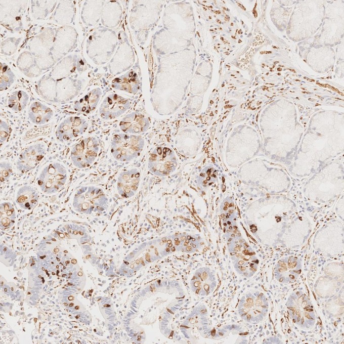 IHC staining of human stomach cancer using 67864-1-Ig